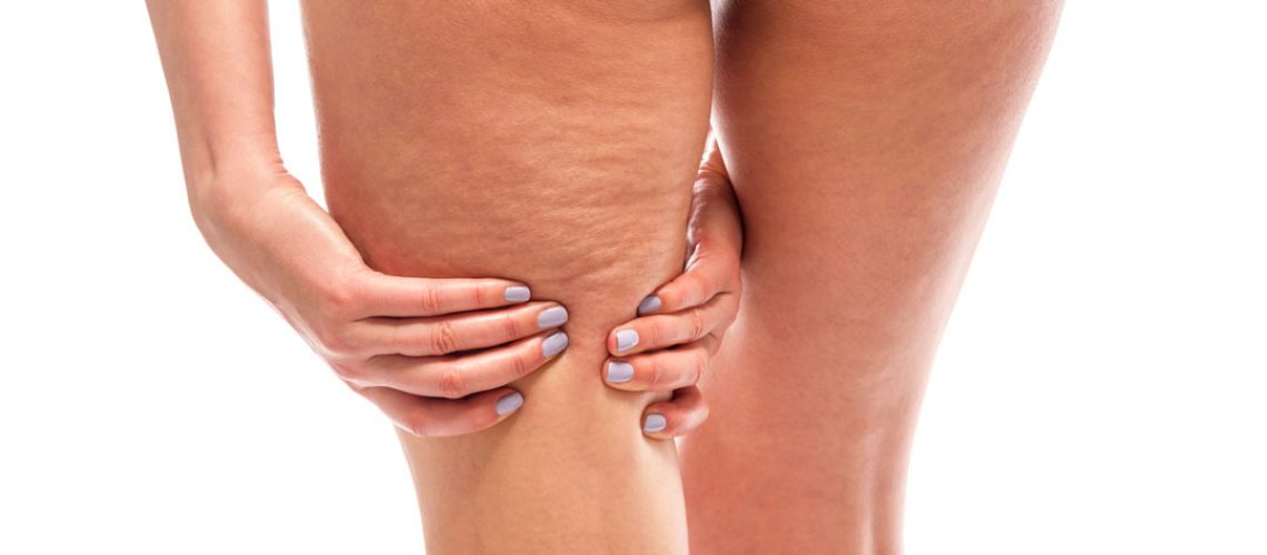 Gluteoplastia corrige celulite?