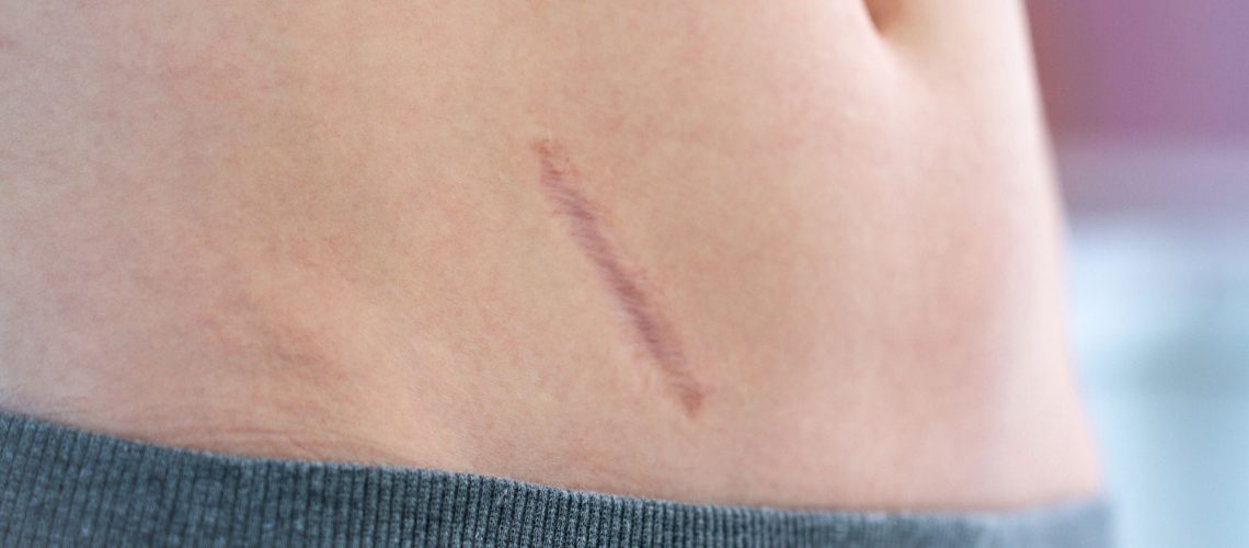 correcao-de-cicatriz-quando-o-procedimento-e-indicad